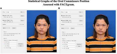 Identifying Modulated Functional Connectivity in Corresponding Cerebral Networks in Facial Nerve Lesions Patients With Facial Asymmetry